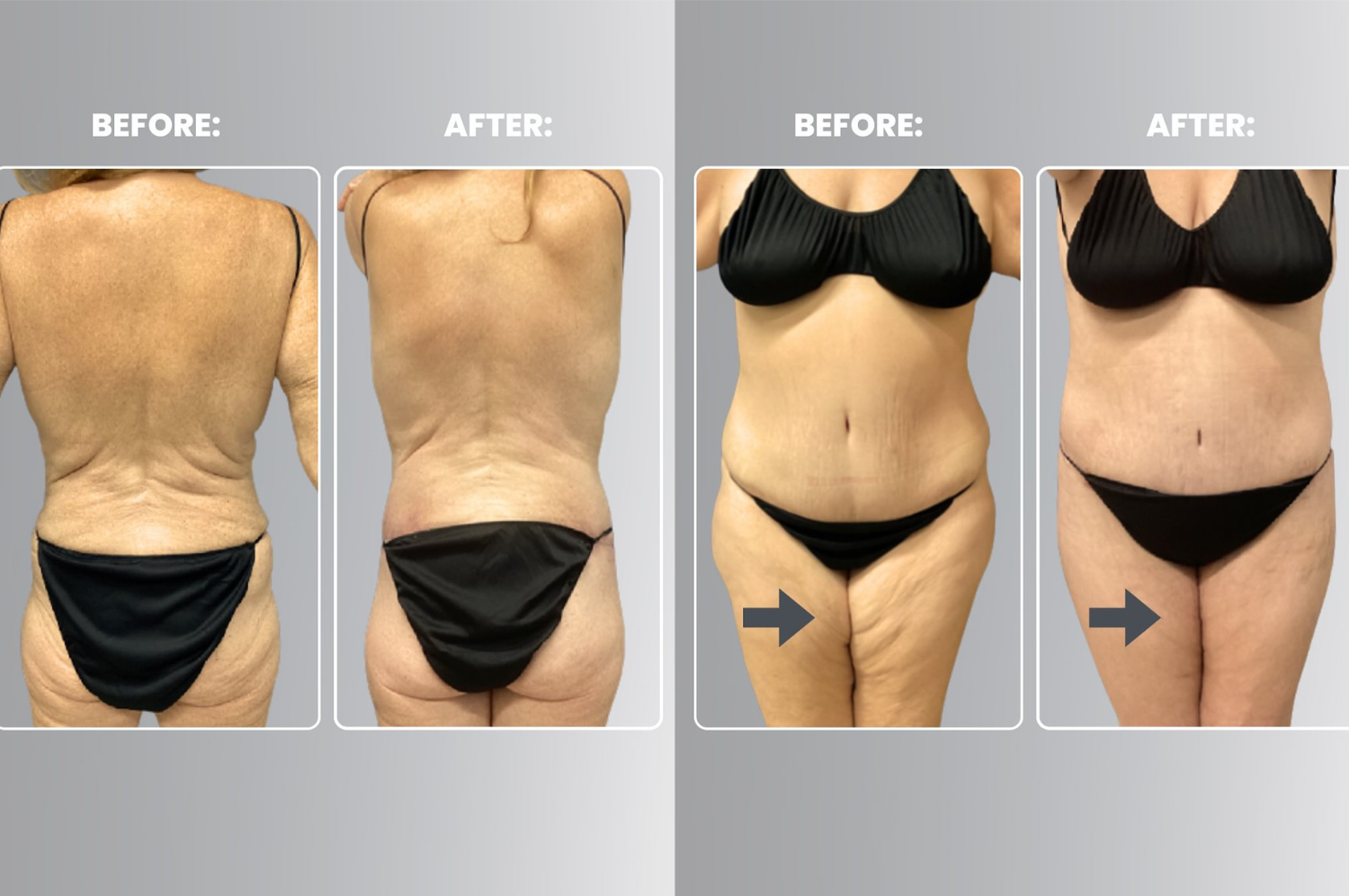 The Game-Changer in Body Contouring: How LiftEX 360 Is Redefining Post-Weight Loss Transformations