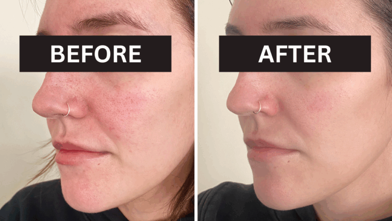 Red Light Therapy Before and After: A Comprehensive Guide to Results ...