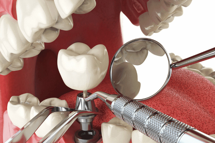 Top Implant Dentistry Trends to Watch in 2026