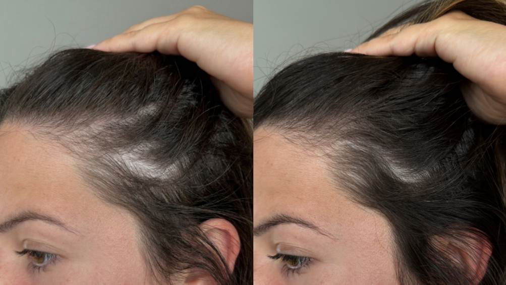 What You Need To Know About KilgourMD’s Clinically Proven Hair Growth System