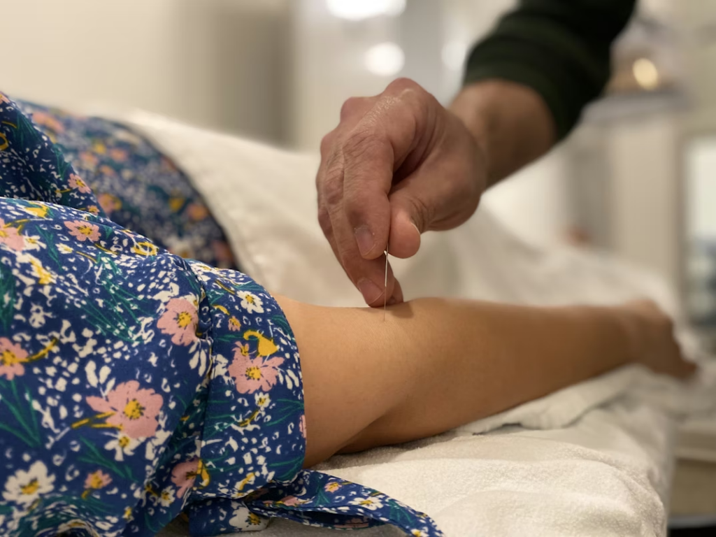 Why More Women Are Turning to Acupuncture for Whole-Body Wellness