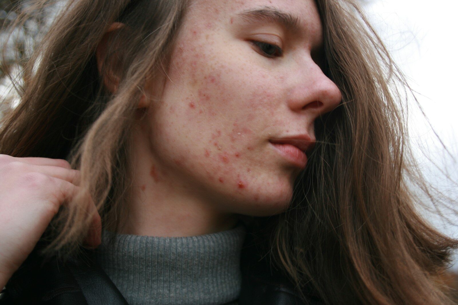 The Best Hormonal Acne Supplement Guide for Clearer Skin